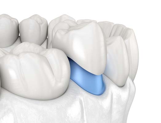 Important Benefits Of Dental Restoration With Tooth Crowns