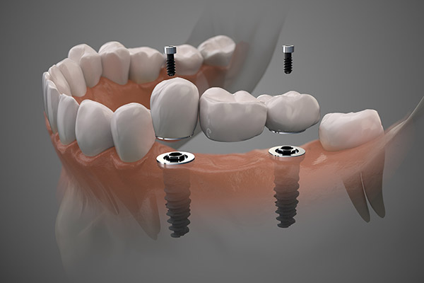 Implant Supported Full Bridge &# ; An Option For Replacing Missing Teeth